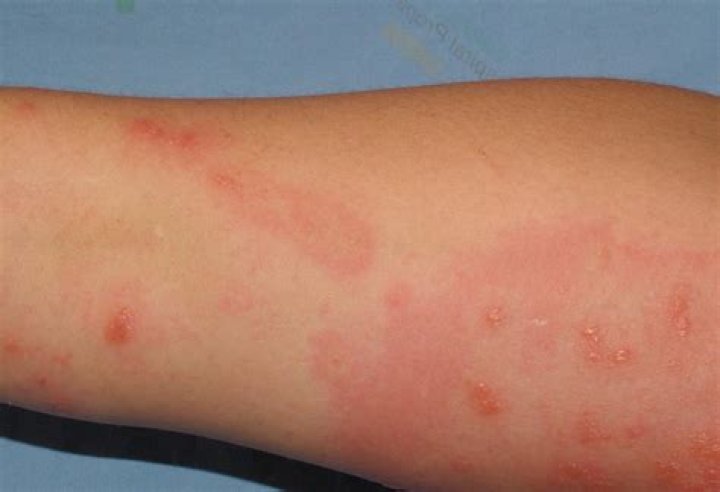 How long does Itchy last?
