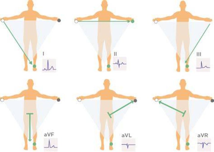 What does RA stand for ECG?