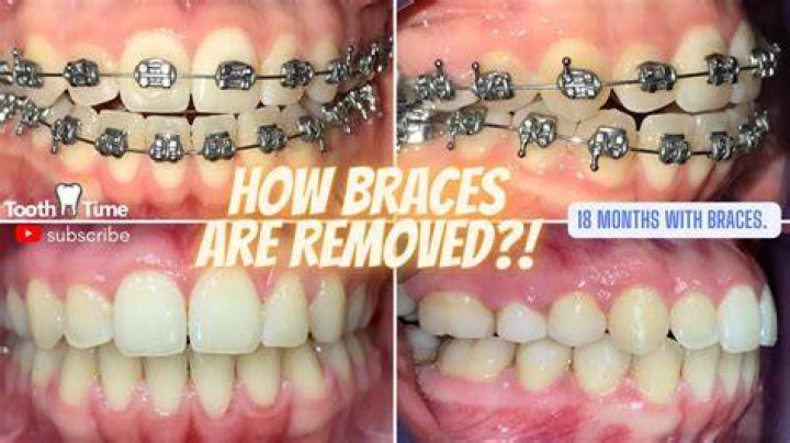 What to do for someone who just got braces?