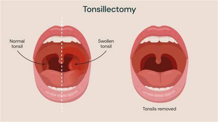 Why tonsillectomy is done?